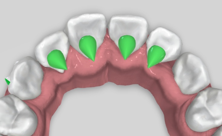 Tongue Trainer Placement